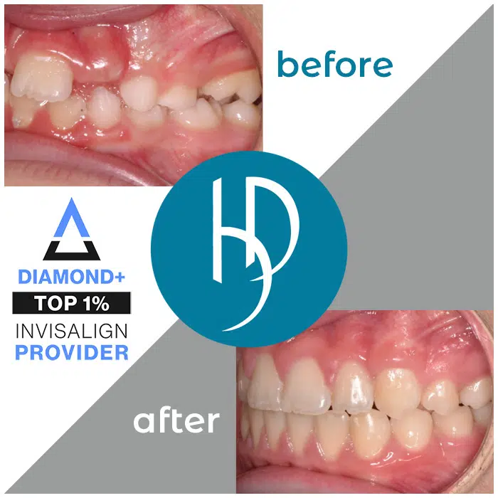 HD-Ortho-crossbite-treatment-harrisburg-pa