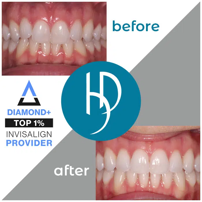 HD-Ortho-crowding-treatment-carlisle-pa