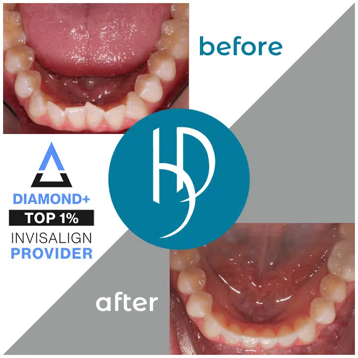 HD-Ortho-crowding-treatment-dauphin-county-pa