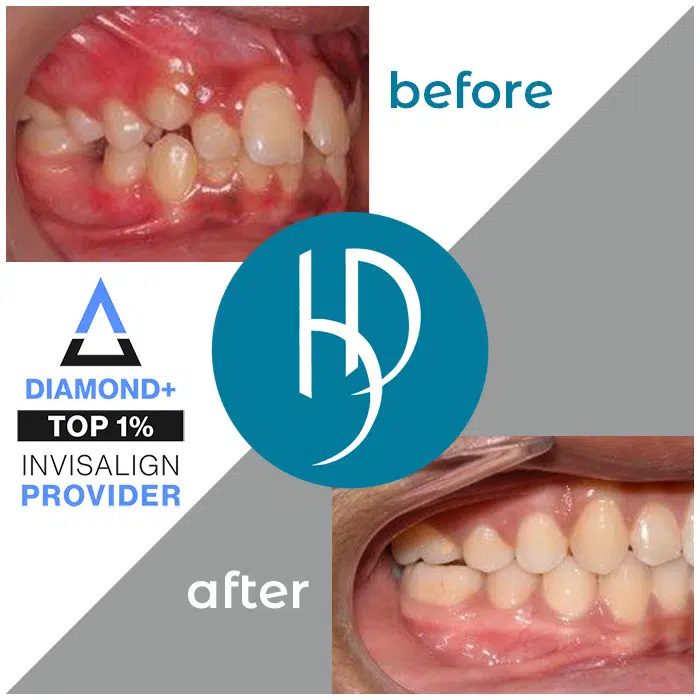 HD-Ortho-impacted-canines-treatment-carlisle-pa