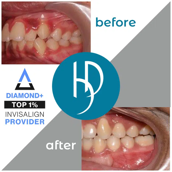 HD-Ortho-impacted-canines-treatment-dauphin-county-pa