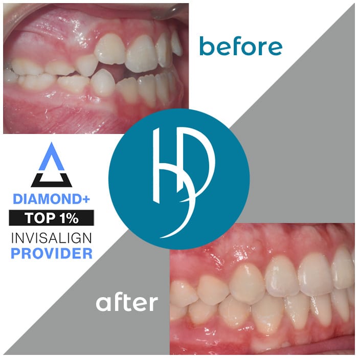 HD-Ortho-openbite-treatment-carlisle-pa