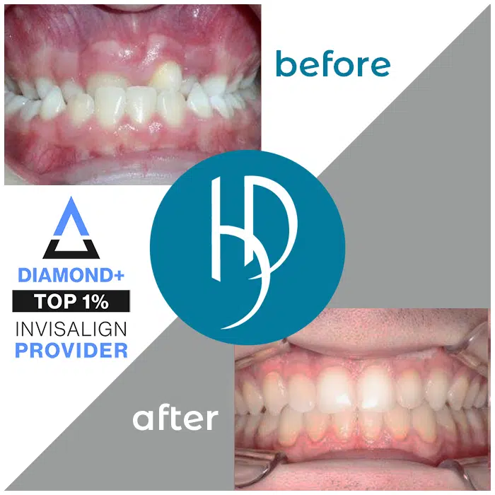 HD-Ortho-HD-before-after-alexander