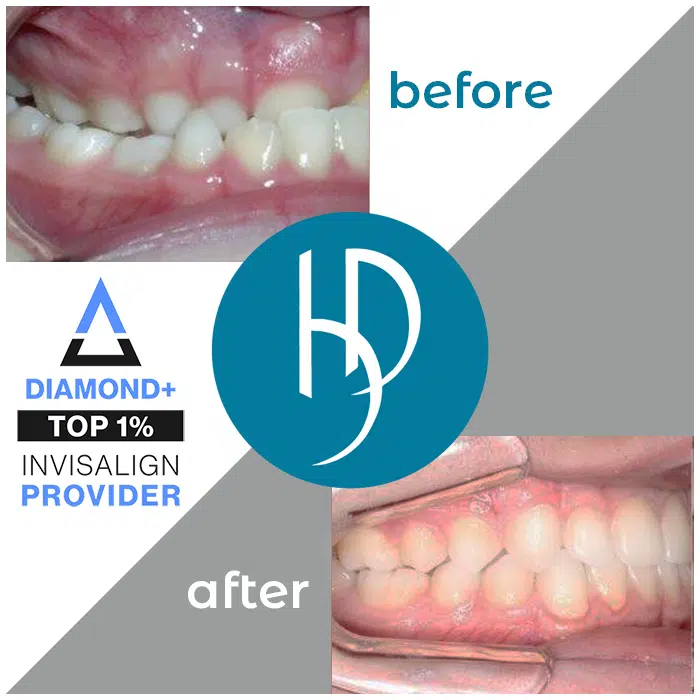 HD-Ortho-HD-before-after-alexander2