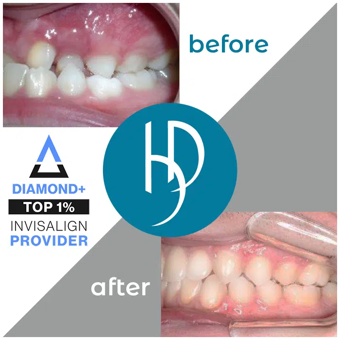 HD-Ortho-HD-before-after-alexander3