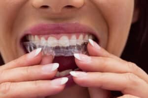 How Does Invisalign Work?