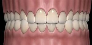 crossbite treatment