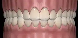 crossbite treatment