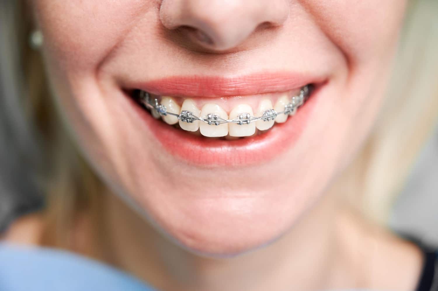 Braces-Friendly Diet: To Include and Avoid for Best Results