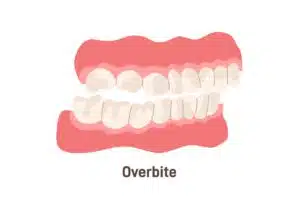 Can Invisalign Fix Overbite