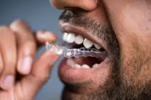 Can Invisalign Fix Overbite