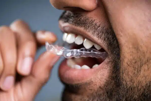 Can Invisalign Fix Overbite