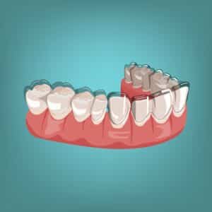 Can Invisalign Fix Overbite
