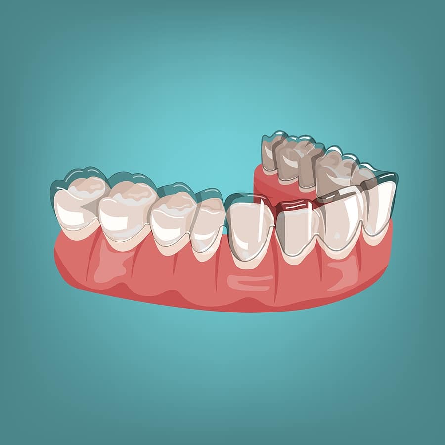 Dealing with Dental Crowding: Is Invisalign the Solution?