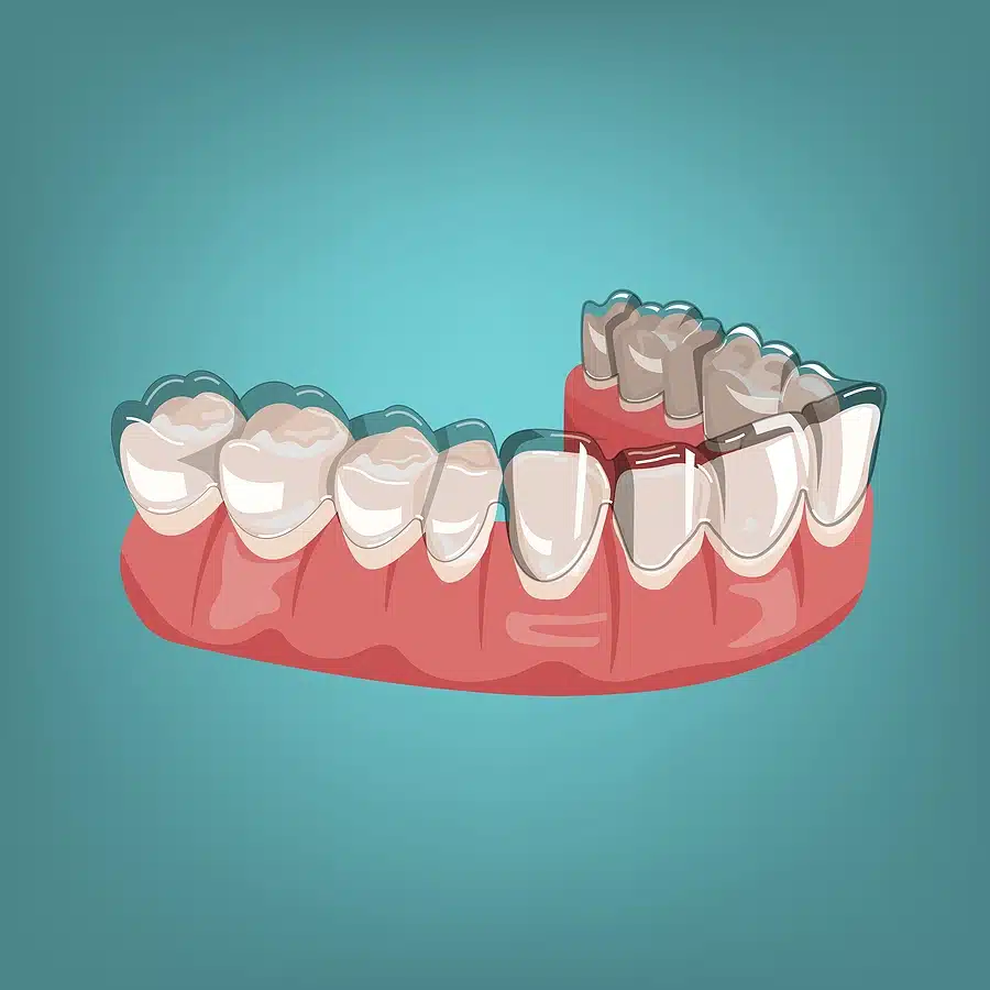 can Invisalign fix crowding