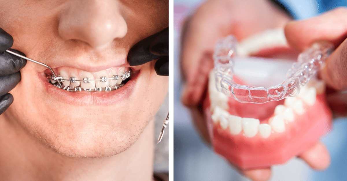 Smile Makeover Showdown: Decoding the Battle Between Invisalign and Braces