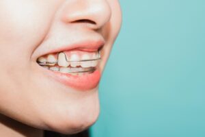 How Long Do You Have To Wear A Retainer