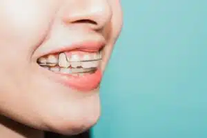 How Long Do You Have To Wear A Retainer