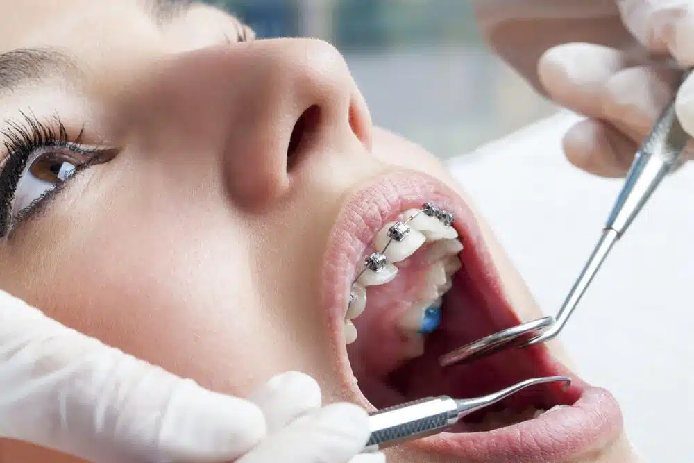 Braces in Carlisle