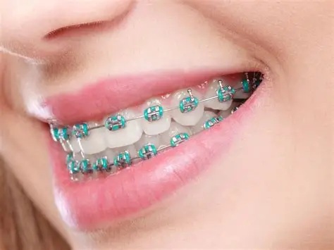 how do braces work
