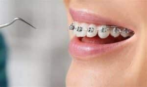 how do teeth braces work