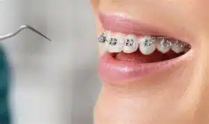 how do teeth braces work