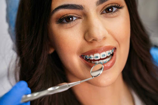 Close-up of a woman showing types of braces for teeth