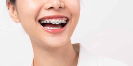 Woman with braces representing different kinds of mouth braces