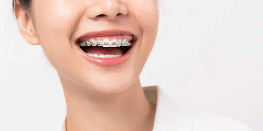 Woman with braces representing different kinds of mouth braces