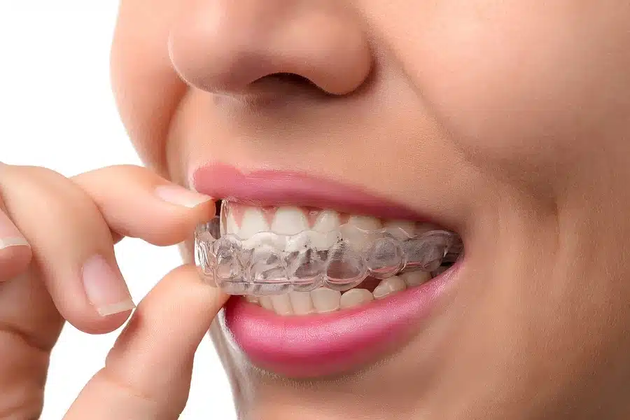 Woman holding an Invisalign near her open mouth