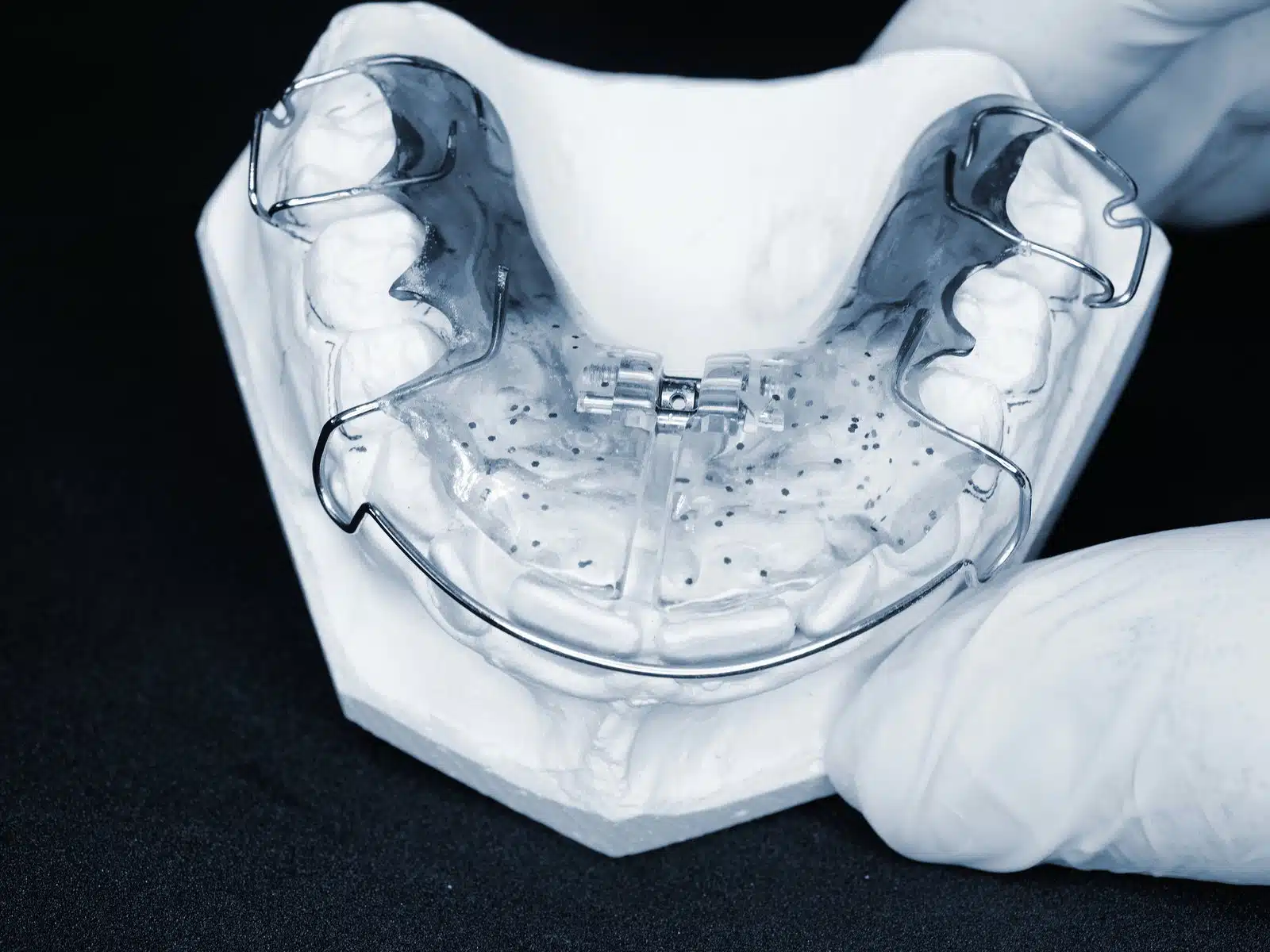 Blue removable orthodontic retainer